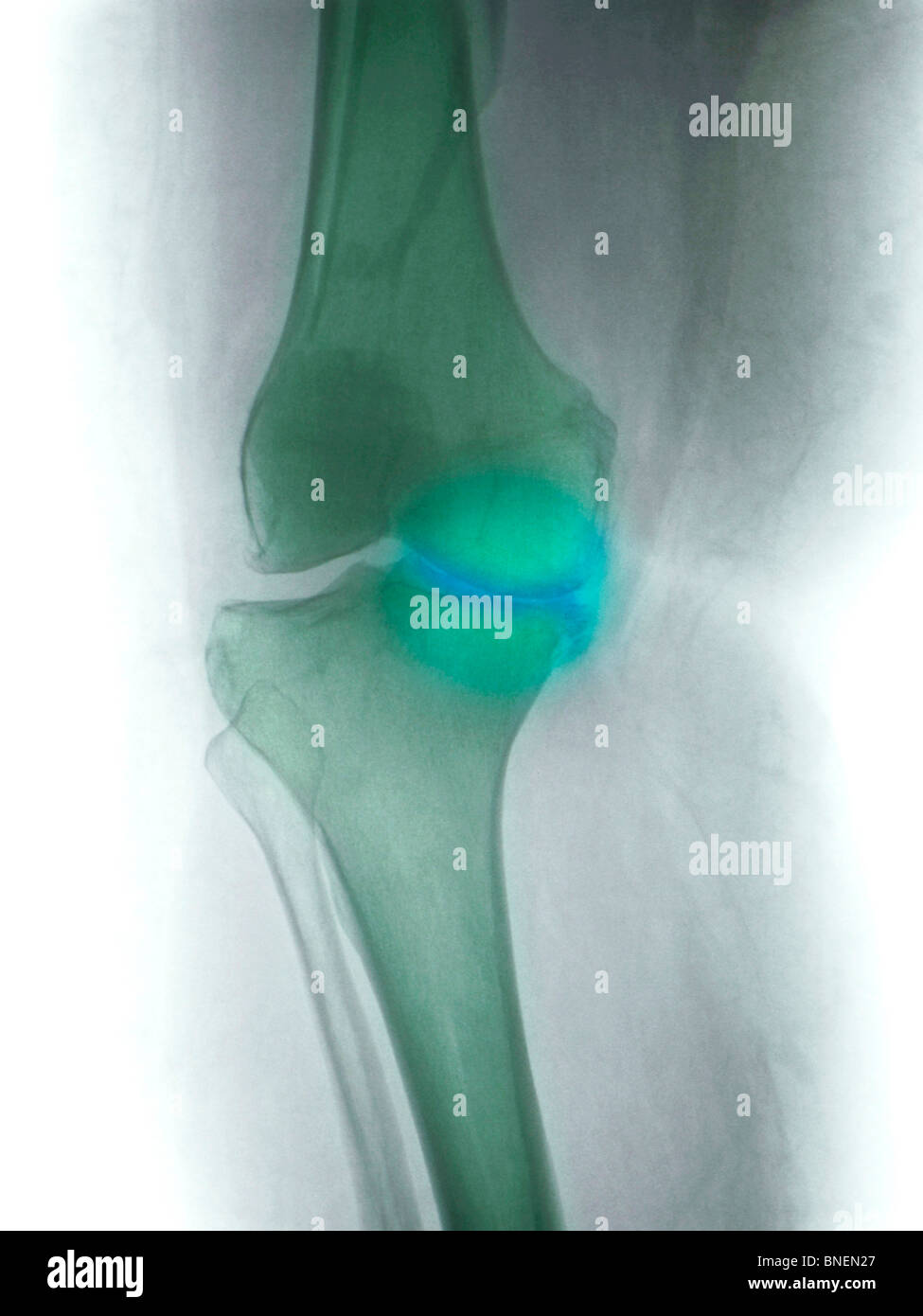 Genou x-ray d'une femme de 60 ans montrant la maladie commune dégénérative d'arthrose Banque D'Images