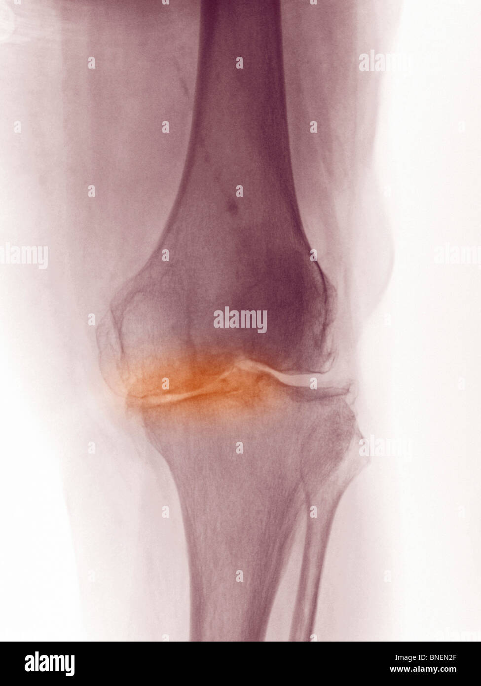 X-ray du genou d'une femme de 83 ans montrant l'arthrite dégénérative. Banque D'Images