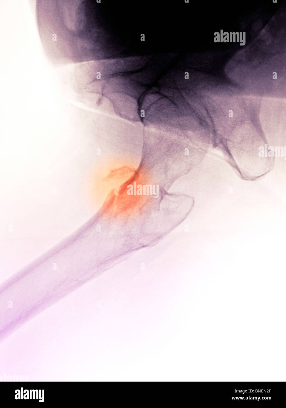 X-ray de la hanche montrant une fracture de la hanche Banque D'Images
