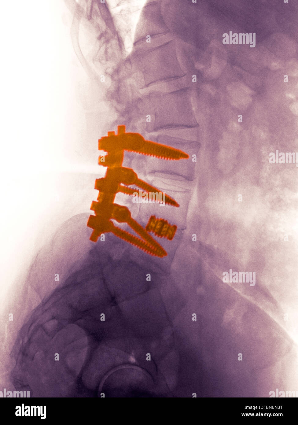 Colonne lombaire retour x-ray de femme de 55 ans montrant une fusion vertébrale Banque D'Images