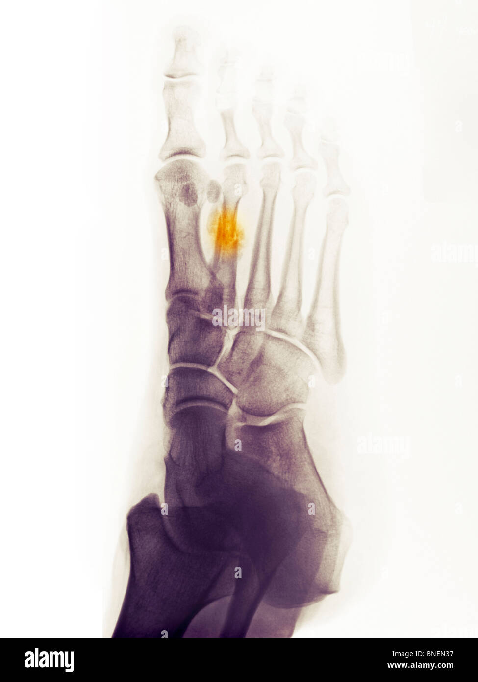 X-ray du pied montrant une fracture guérison 2e métatarsien. Banque D'Images