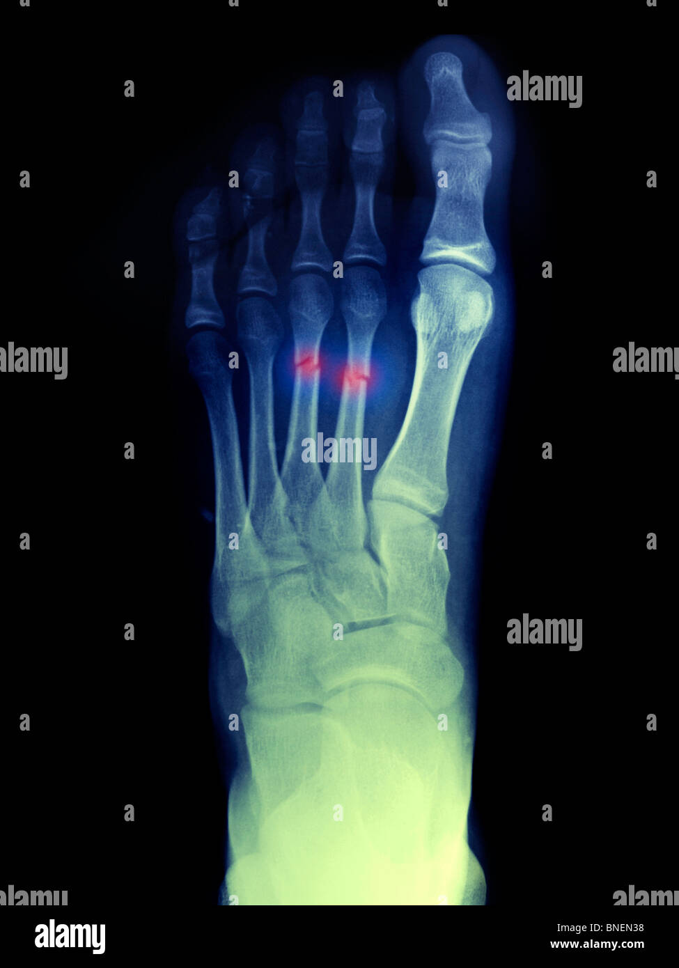Pied x-ray montrant des 2e et 3e métatarsiens Banque D'Images
