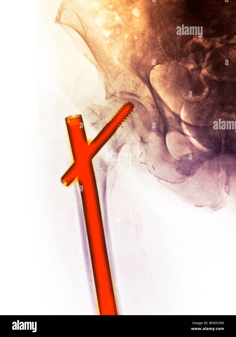 X-ray montrant la hanche fracture de la hanche Banque D'Images