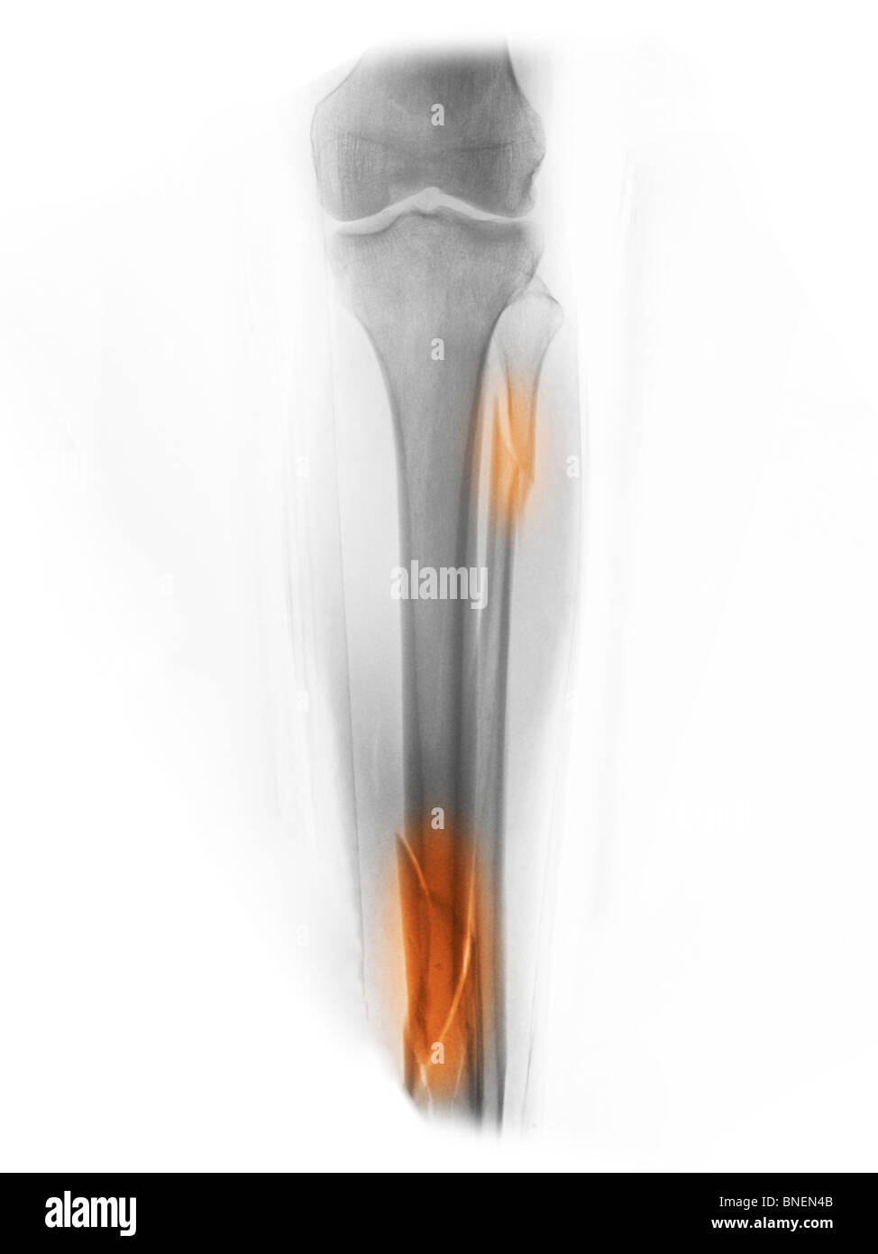 X-ray montrant des fractures comminutives du tibia et du péroné Banque D'Images