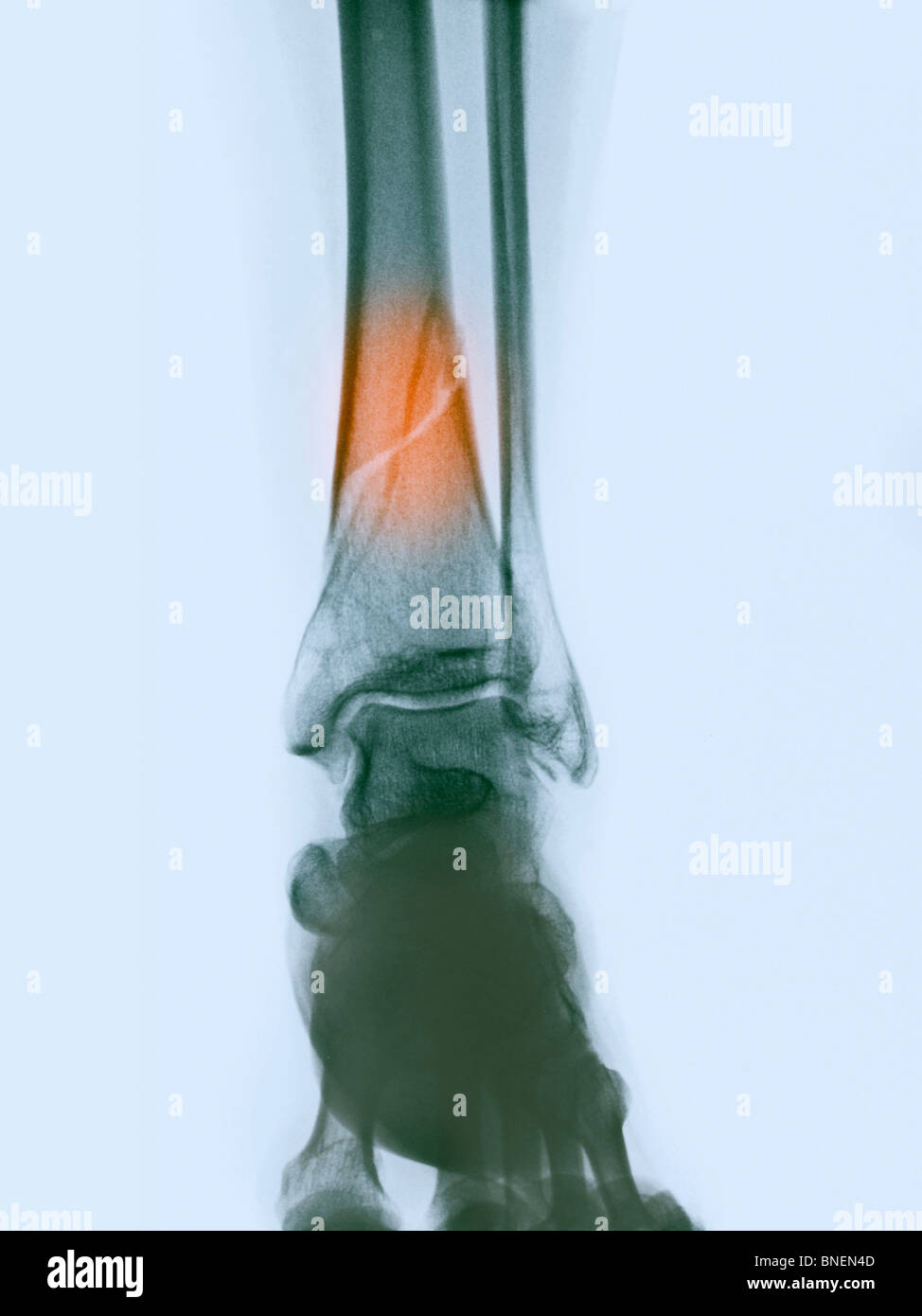 Radiographie d'une fracture de la jambe inférieure Banque D'Images