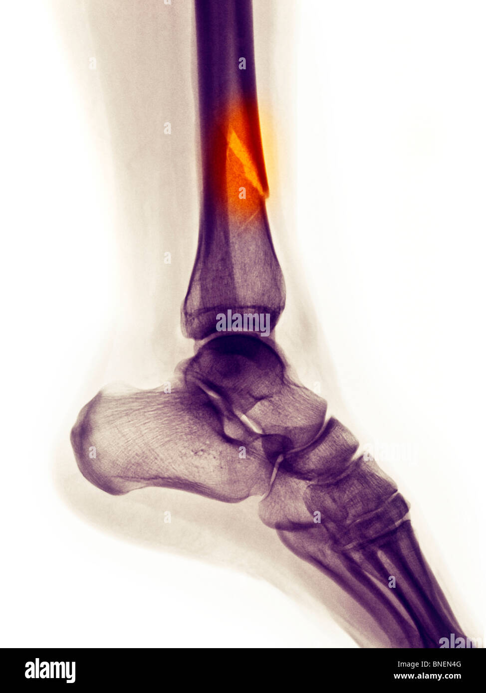 Jambe fracture montrant des rayons x Banque D'Images