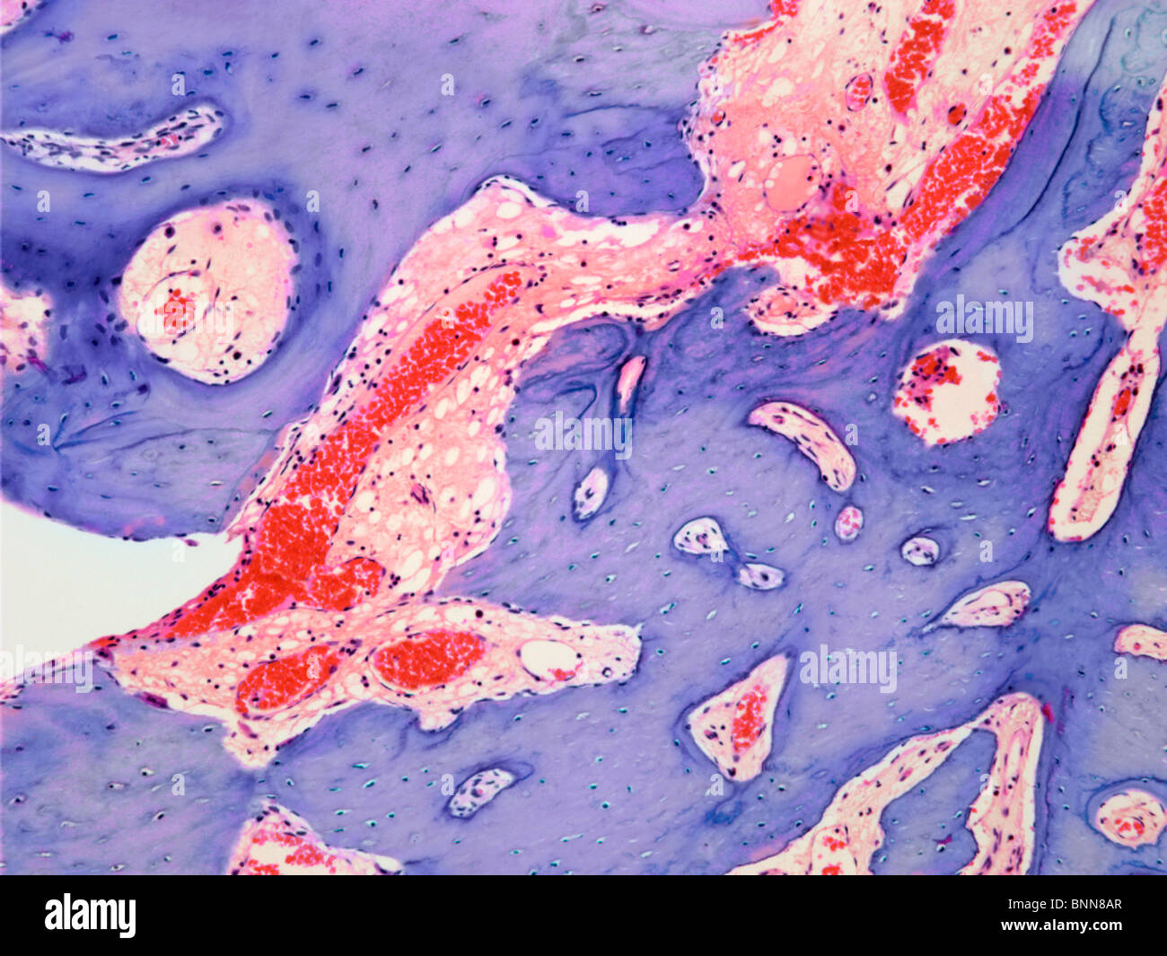 Ostéome ostéoïde, lumière microphotographie Banque D'Images
