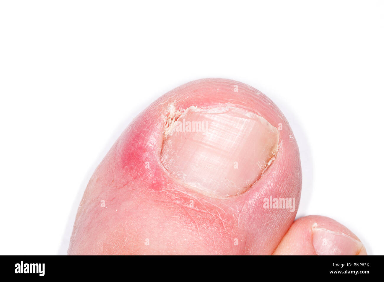 Un modèle publié close up photo d'un ongle incarné ongle ( ) au Royaume-Uni Banque D'Images