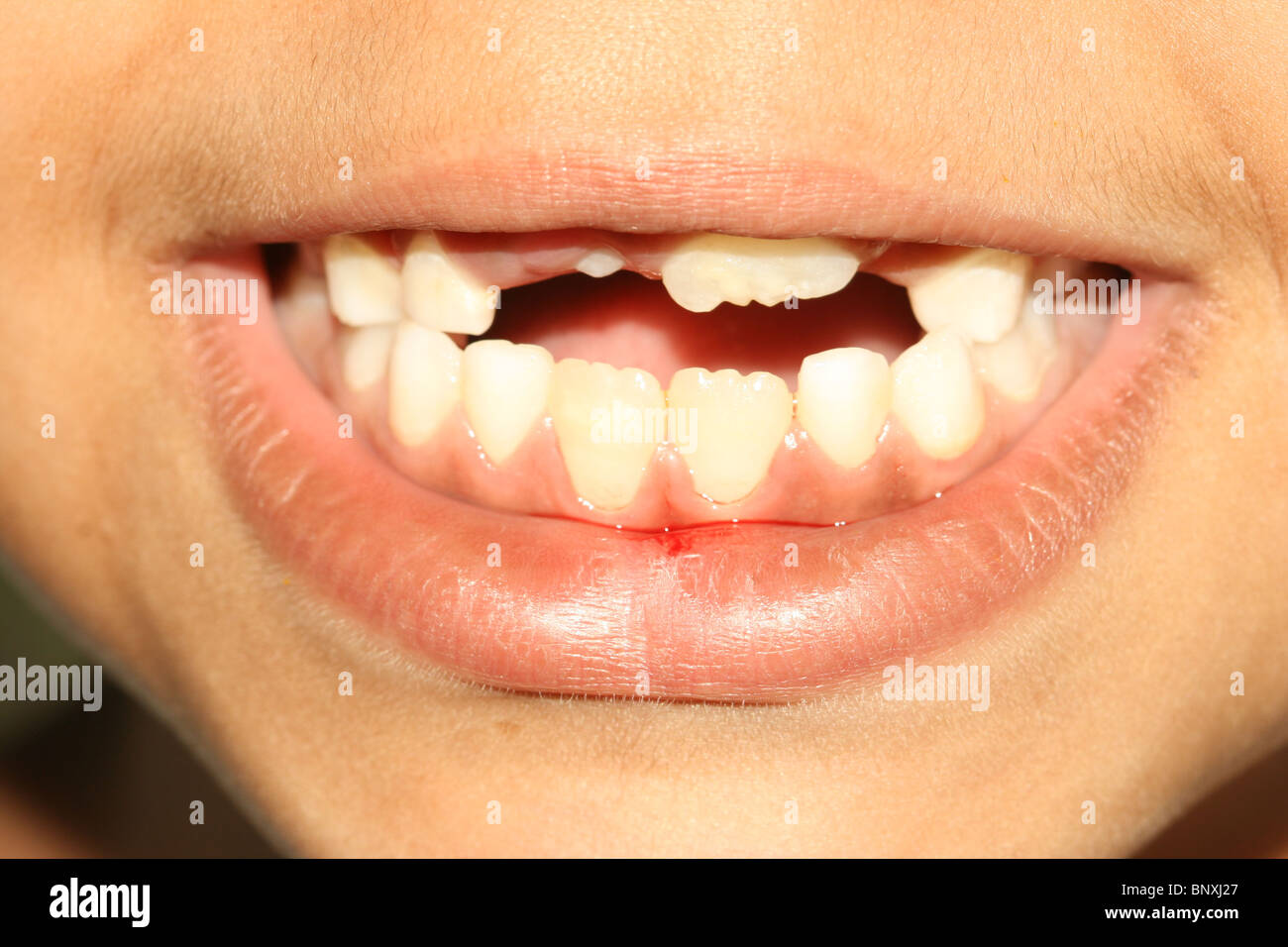 Une jeune fille avec de nouvelles dents où émergent les dents de lait sont tombés Banque D'Images