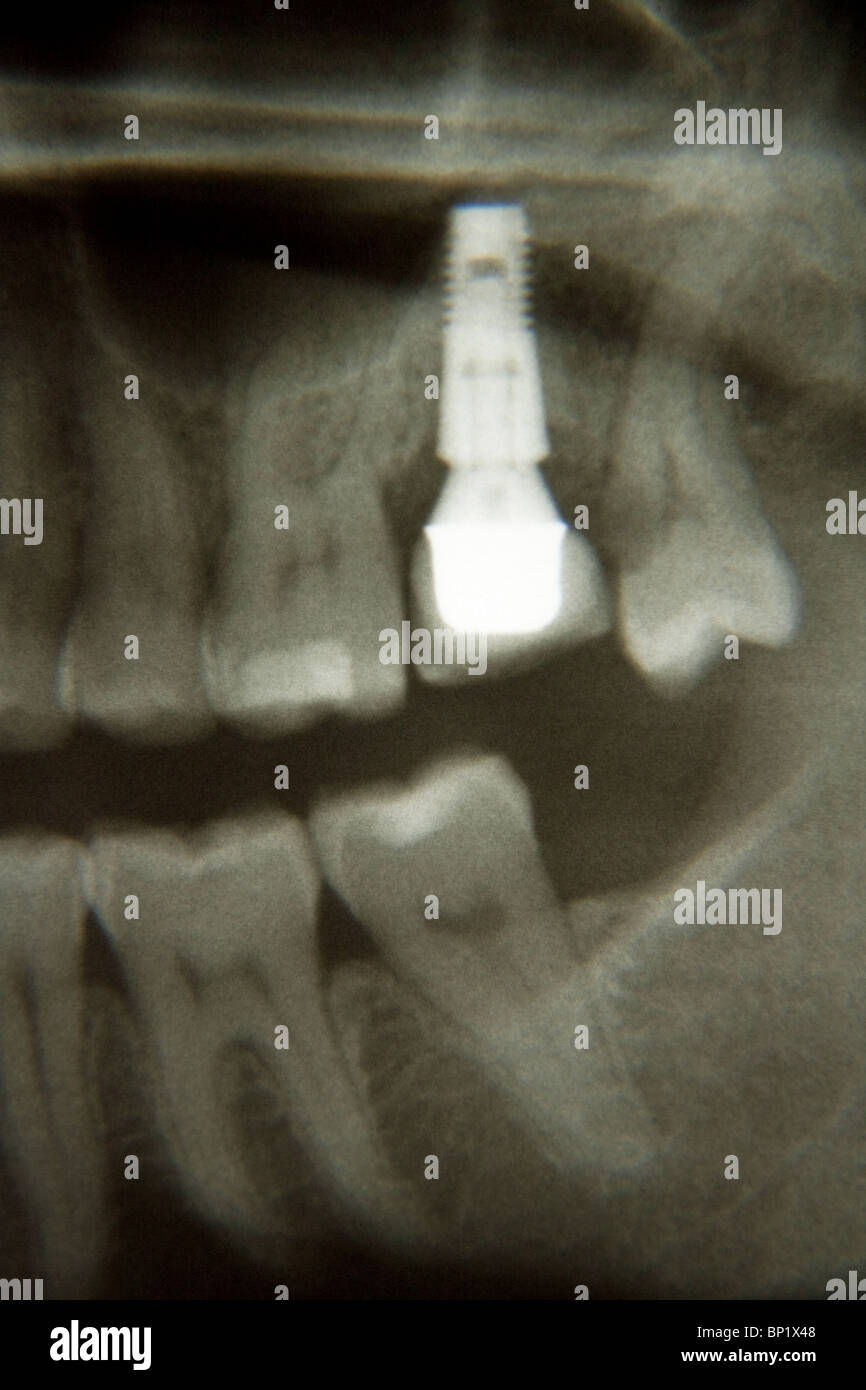 Radiographie de l'implant dentaire Banque D'Images