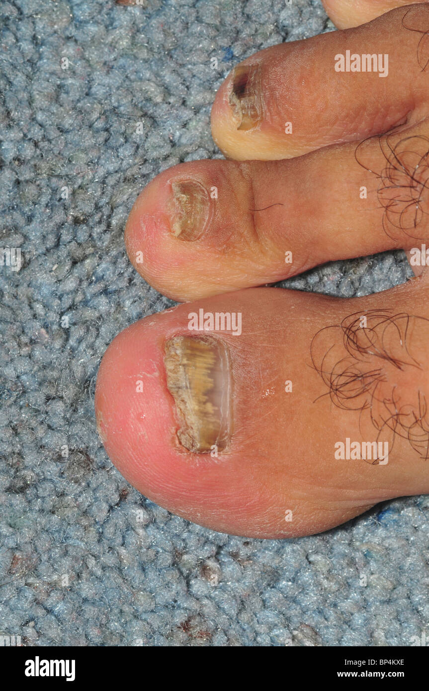 L'infection fongique. Vue de la casse, décolorées et mal les ongles des orteils de plus en plus infectés par le champignon (tinea unguium) Banque D'Images