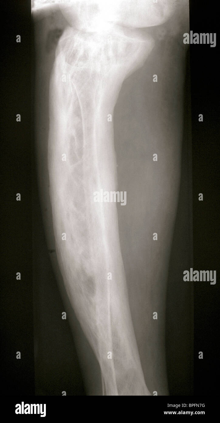 X-Ray montrant la maladie de Paget de l'os du tibia Banque D'Images