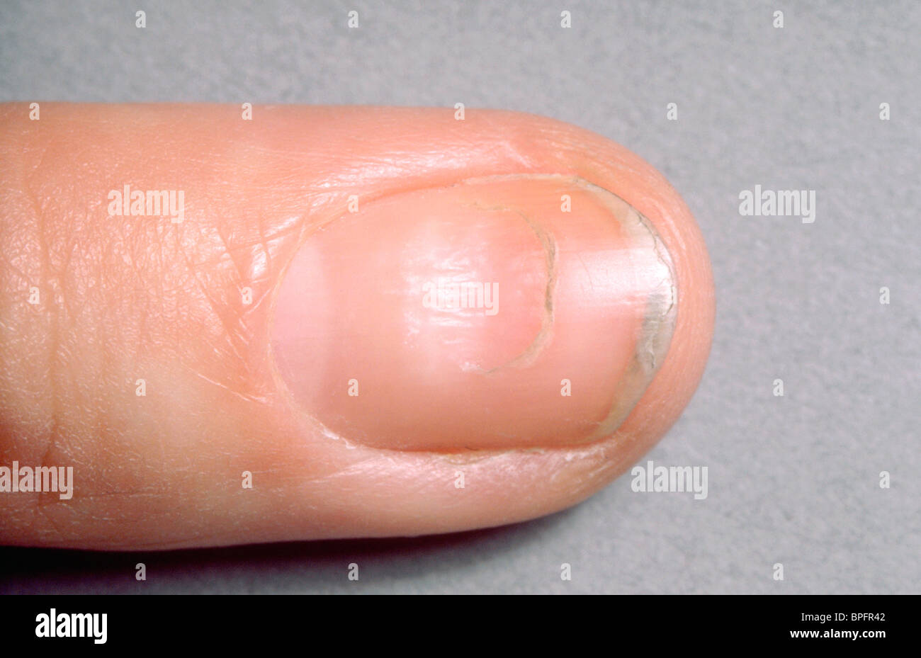 Unguinal Photos Unguinal Images Alamy