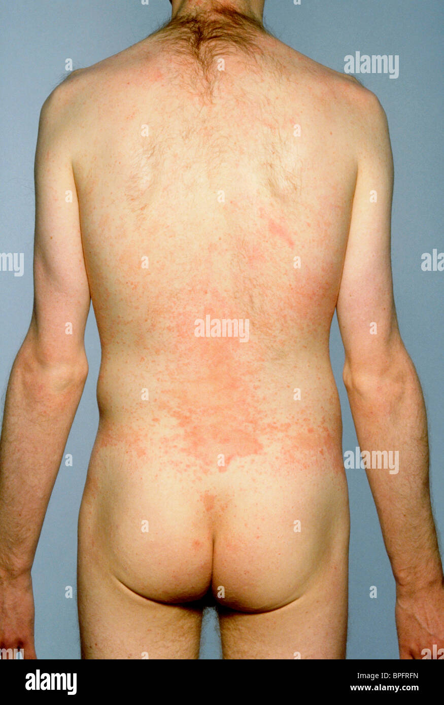 L'arrière d'un patient ayant une maladie mycotique de la peau. Banque D'Images