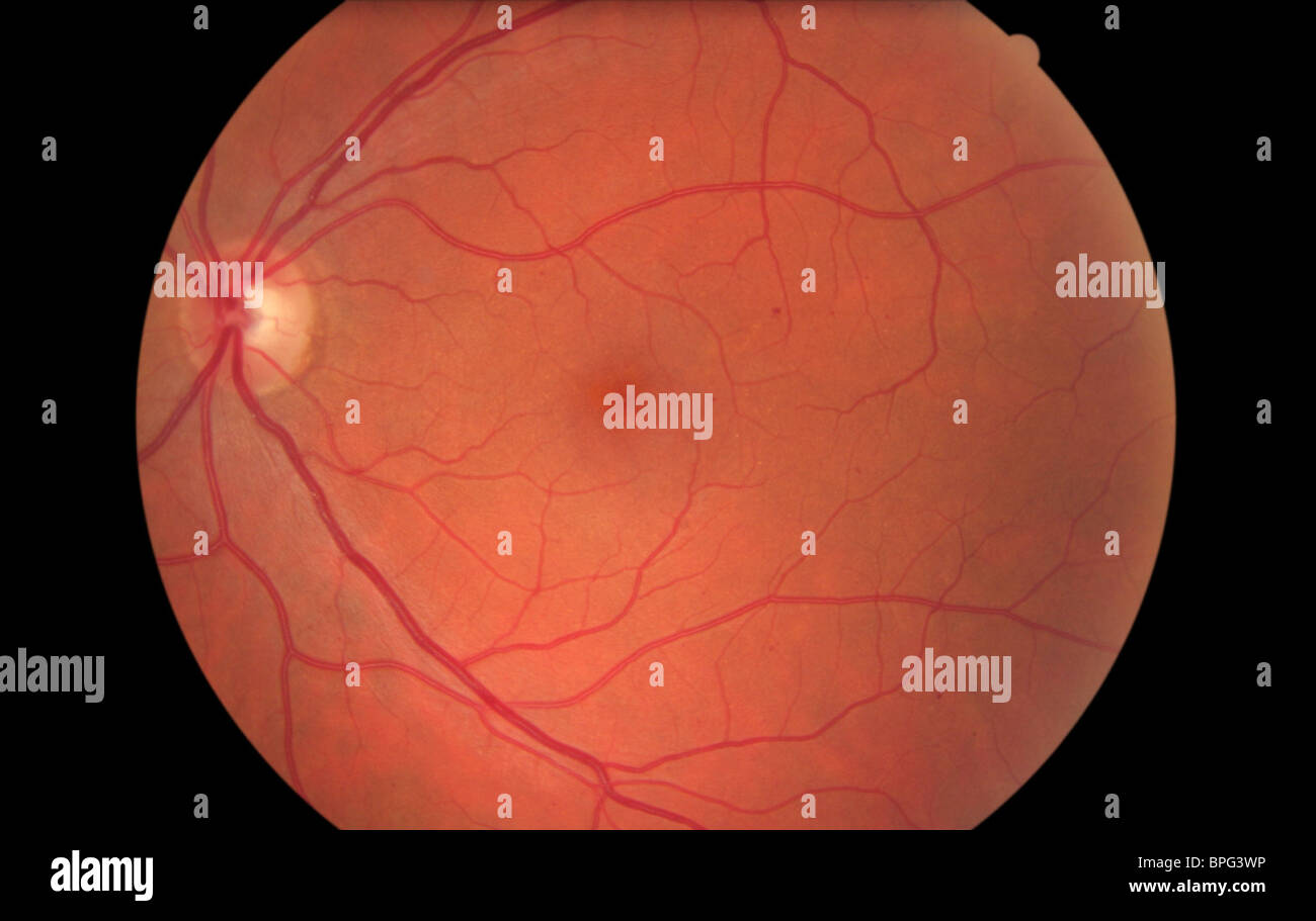 Contexte La rétinopathie diabétique ou BDR est nommé de façon appropriée parce qu'elle se trouve dans l'arrière-plan. Banque D'Images
