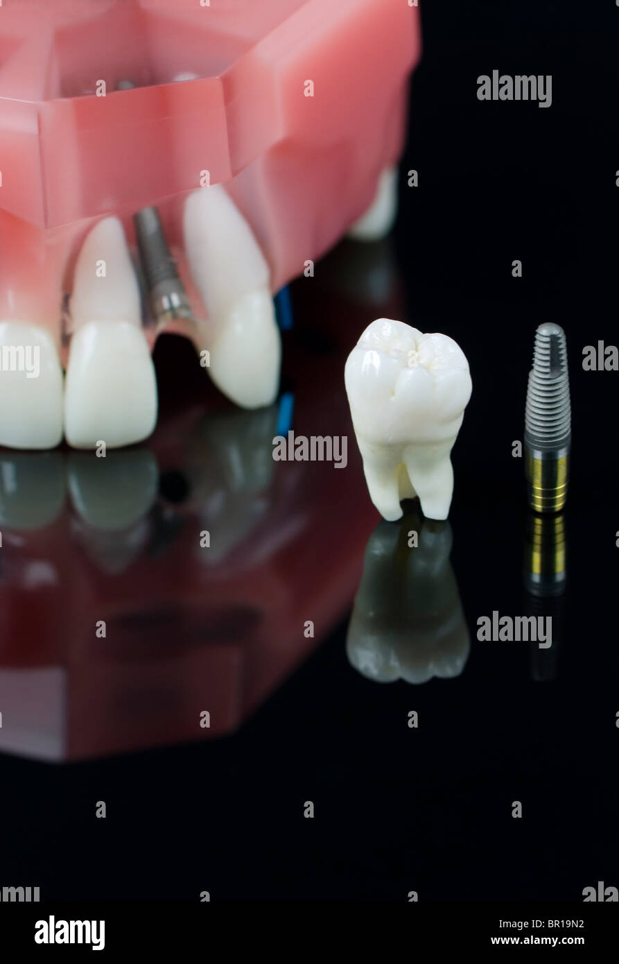 Dent de sagesse humaine réelle, les implants dentaires et les dents en plastiques model Banque D'Images