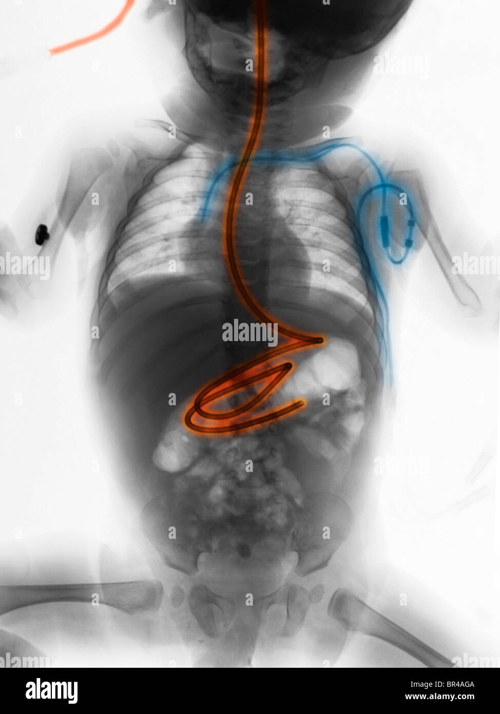 Corps radiographie d'un garçon âgé de 5 mois avec un tube d'alimentation et d'une ligne centrale Banque D'Images