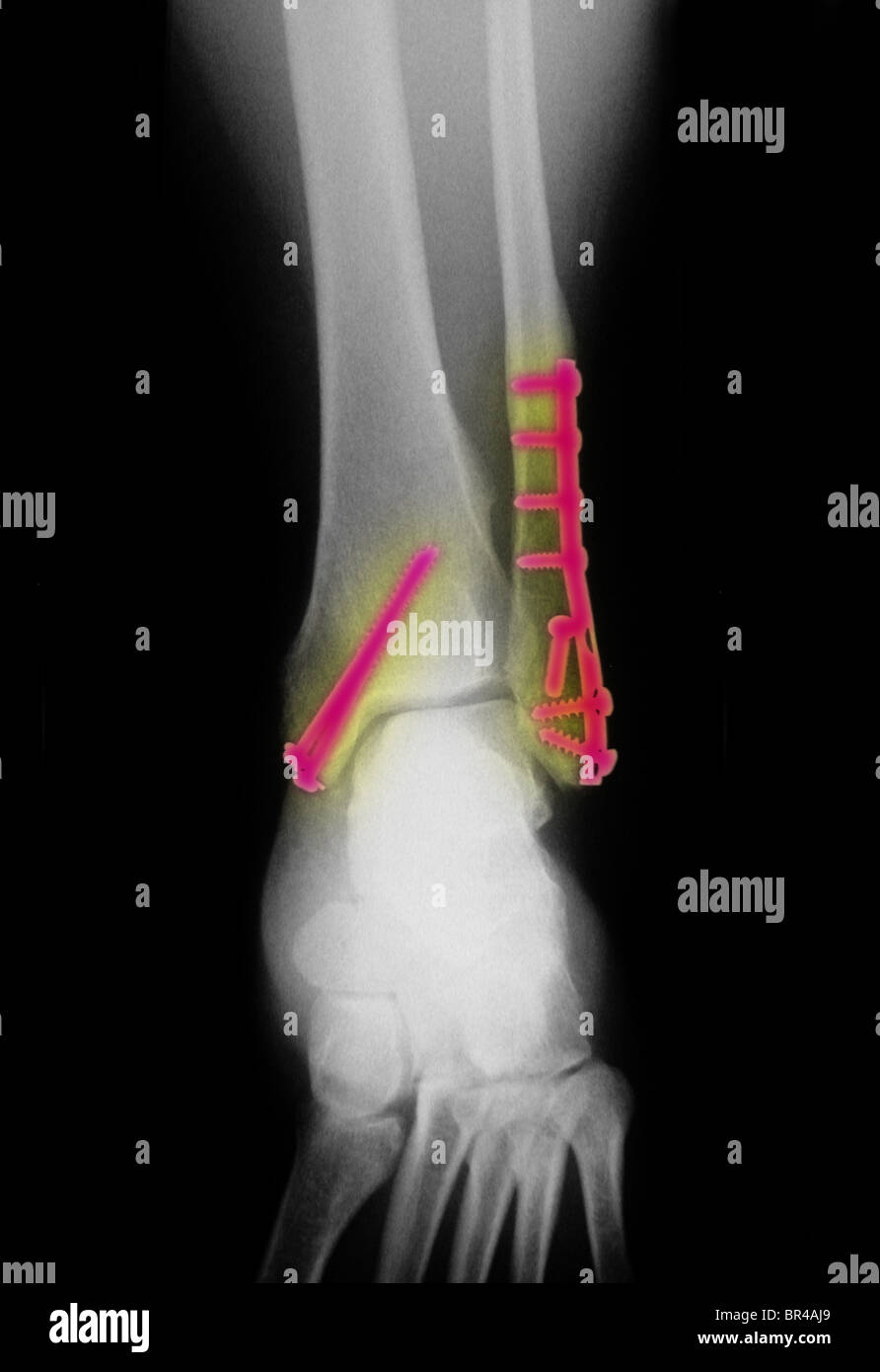 X-ray de la cheville d'un homme de 26 ans montrant des vis et des plaques utilisées pour réparer une fracture et luxation de la cheville Banque D'Images
