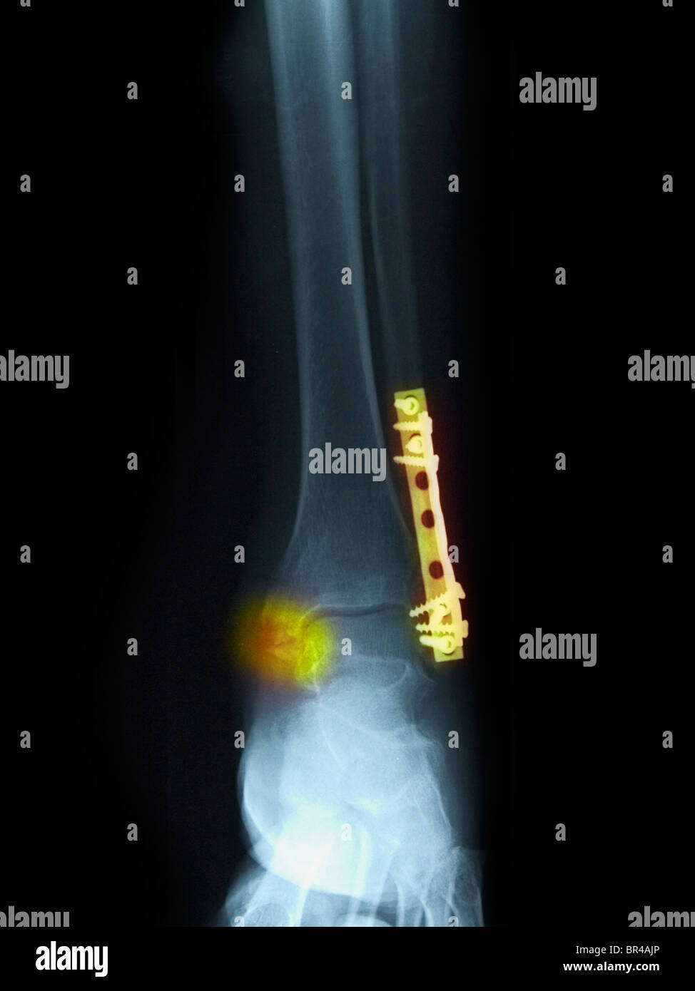 X-ray montrant la réparation d'une fracture et luxation de la cheville Banque D'Images