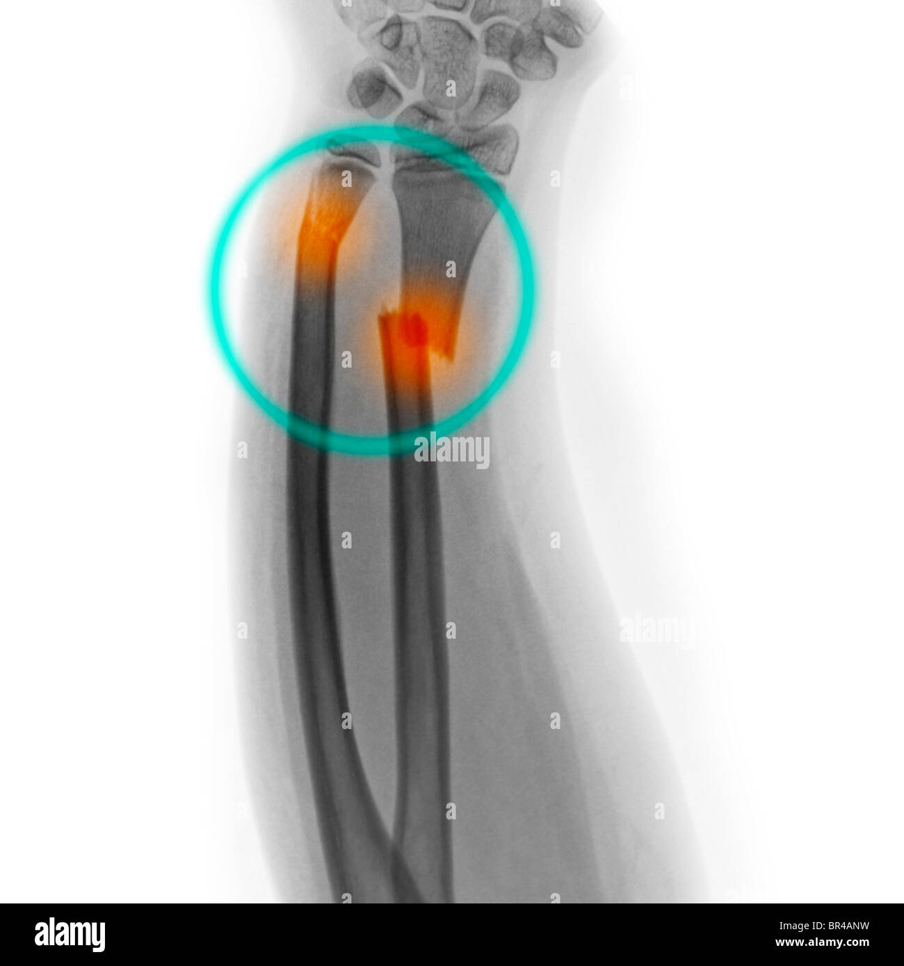 X-ray de l'avant-bras d'une fille de 9 ans présentant des fractures de l'extrémité distale du radius et du cubitus Banque D'Images