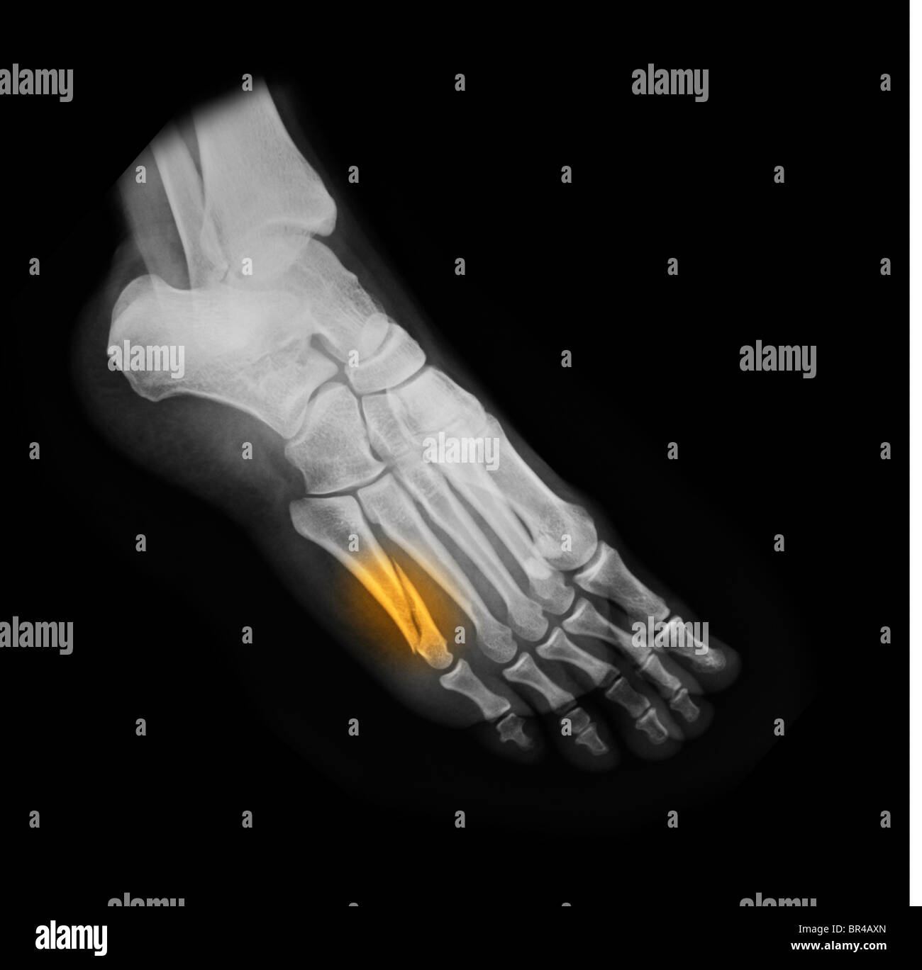 Pied x-ray of a 37 ans avec une fracture de la 5ème métatarsien Banque D'Images