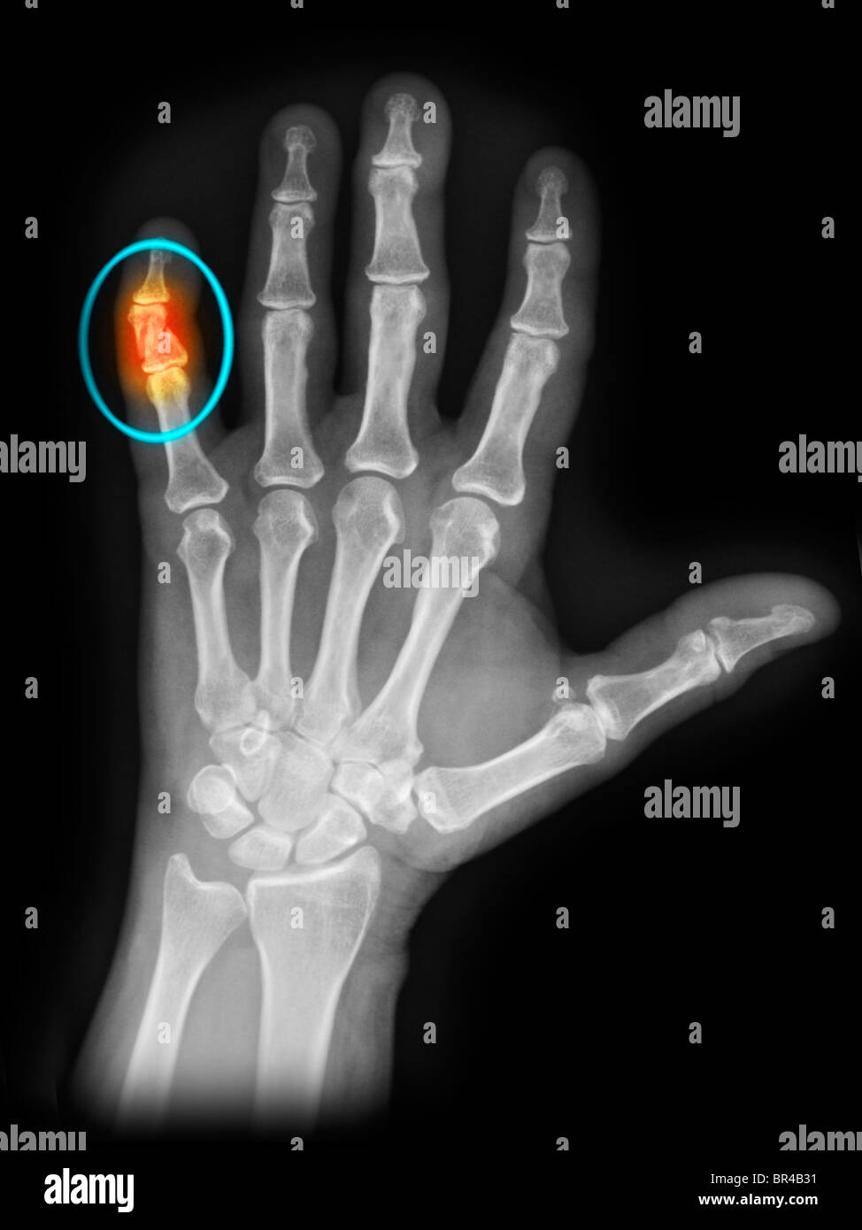 Doigt Cassé Banque d