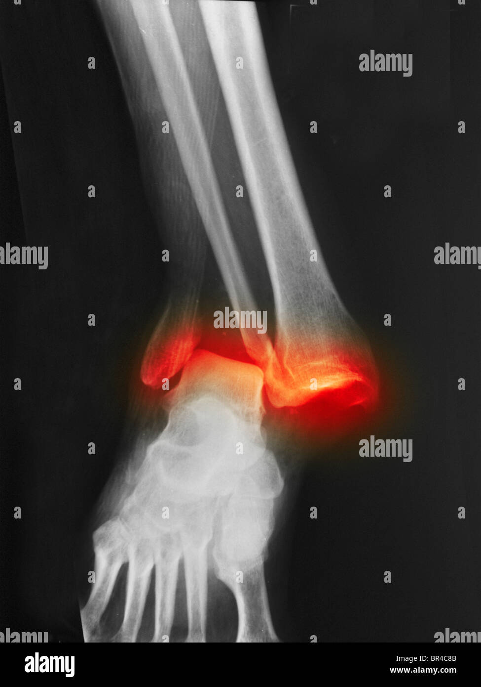 X-ray montrant une fracture et luxation de la cheville dans un homme de 40 ans Banque D'Images