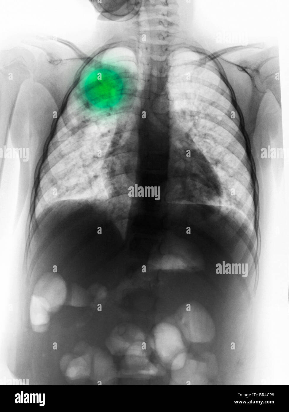 Radiographie montrant une pneumonie en un 5 ans, fille, radiographie pulmonaire montrant la pneumonie dans le lobe supérieur droit d'une fillette de 5 ans Banque D'Images