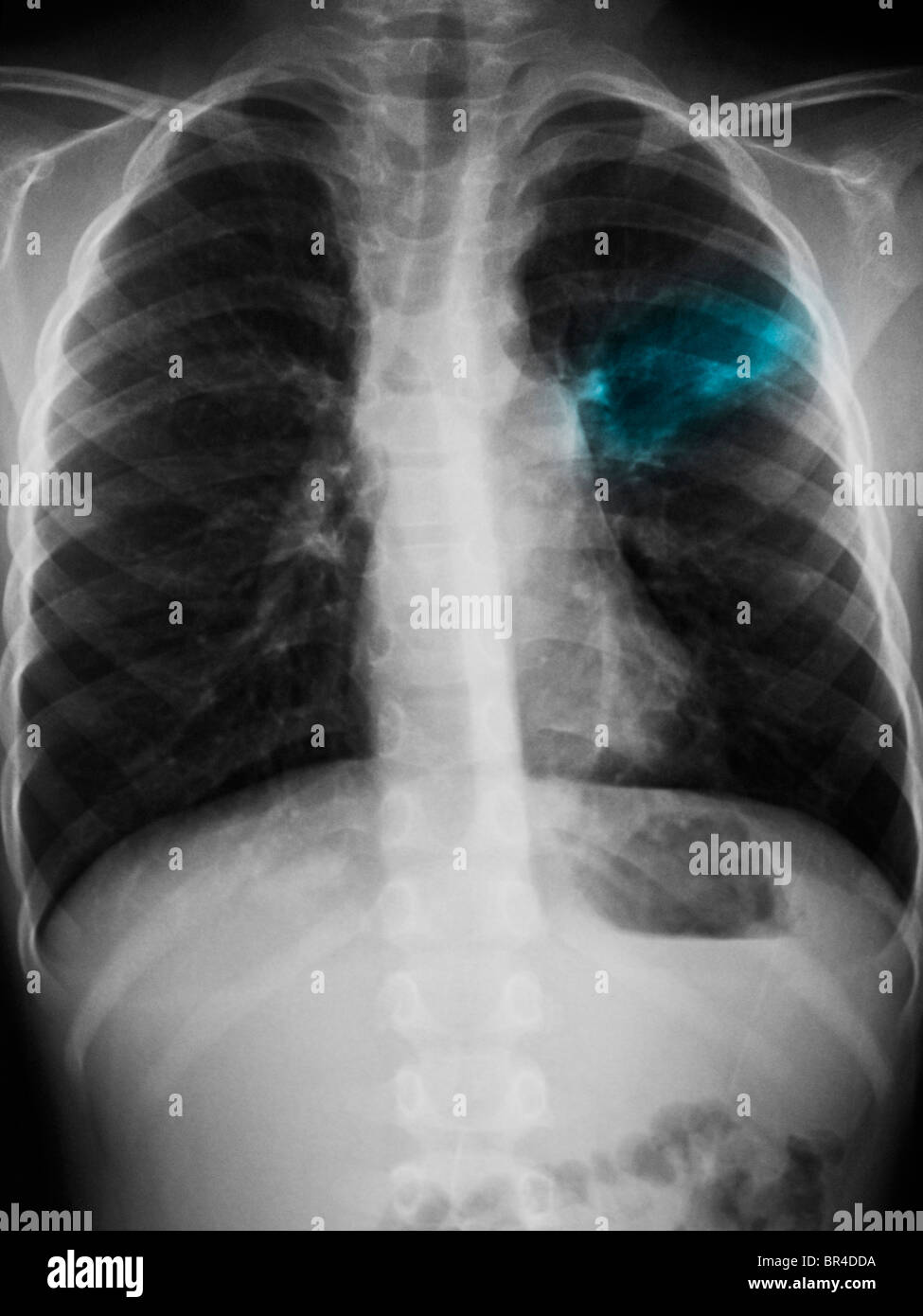 Radiographie d'un garçon de 5 ans montrant un infiltrat lobe supérieur gauche évocateurs d'une pneumonie. Banque D'Images