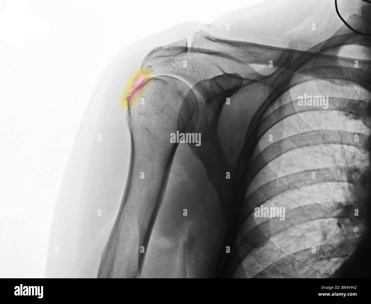 X-ray montrant biceps tendonitis calcifiée dans un 39 ans Banque D'Images
