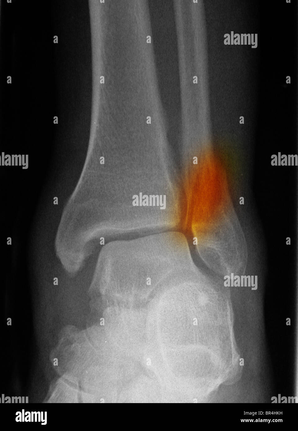 X-ray montrant une fracture de la cheville dans un vieil homme de 66 ans Banque D'Images