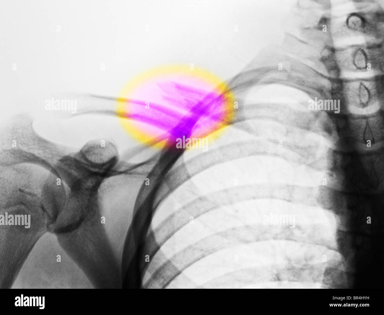 Radiographie d'une fracture de la clavicule. Banque D'Images
