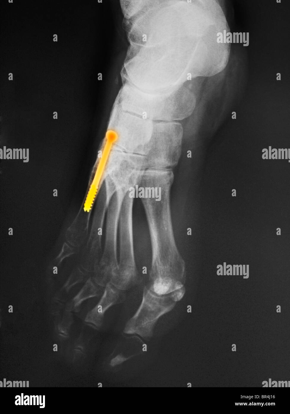 X-ray de la jambe d'une femme de 43 ans qui a subi une chirurgie au 5ème métatarsien où il y a une vis dans l'os Banque D'Images