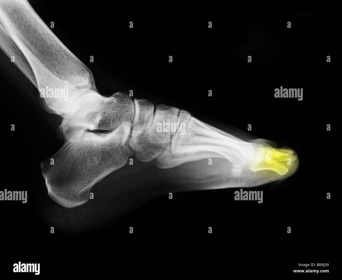 Pied x-ray of a 25 year old man montrant l'extrémité distale l'absence congénitale d'os dans les orteils Banque D'Images