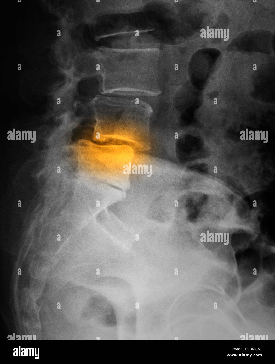 X-ray montrant spondylolisthésis de la colonne lombaire Banque D'Images