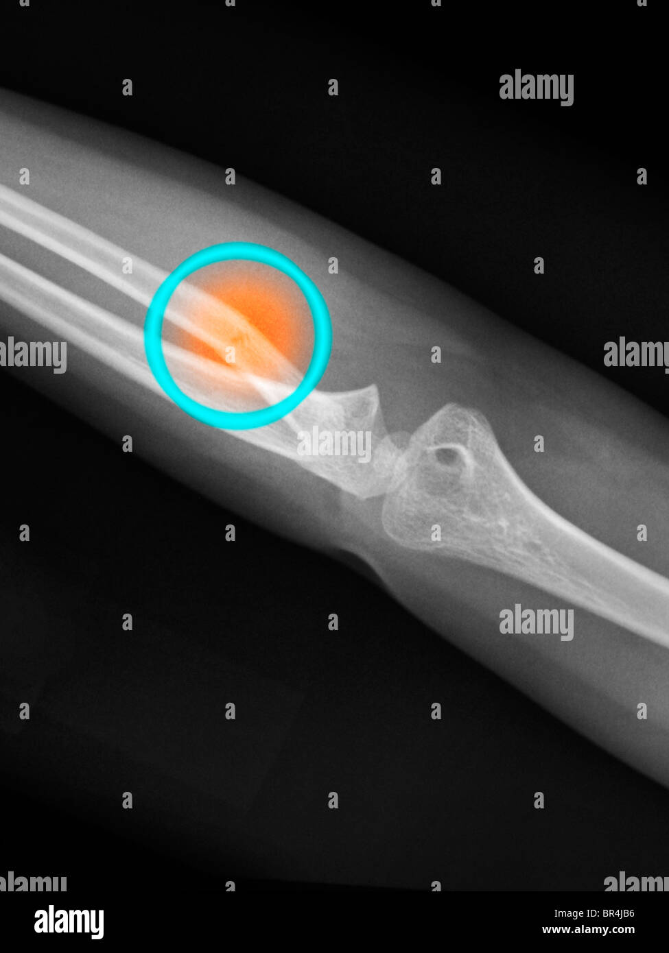 X-ray coude d'une fille de 4 ans qui s'est fracturée le radius et cubitus proximal Banque D'Images