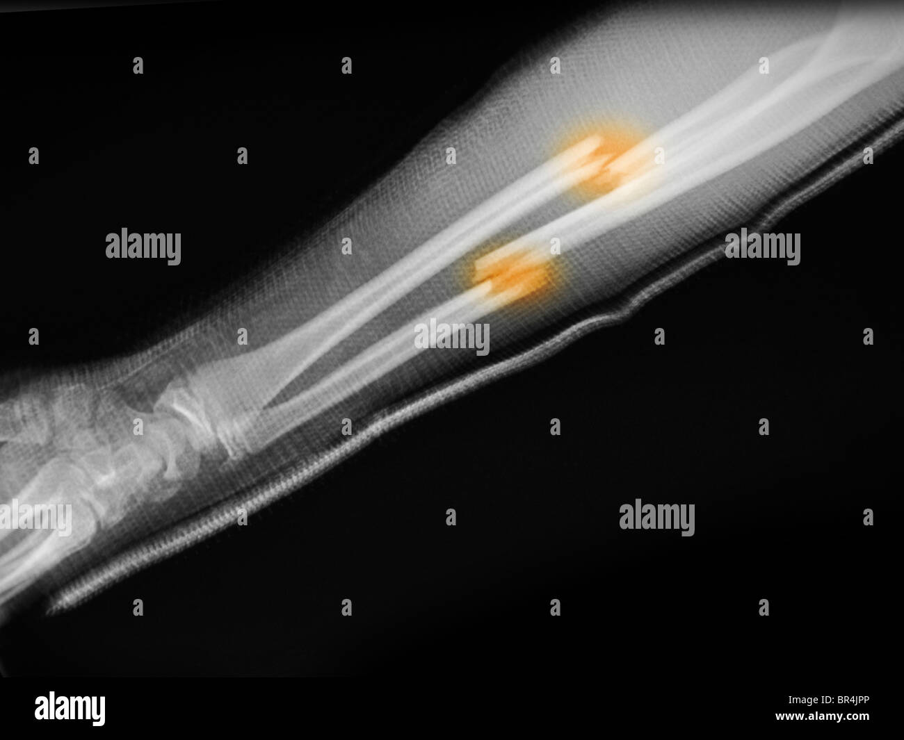 X-ray montrant une fracture de l'avant-bras d'un garçon de 16 ans Banque D'Images