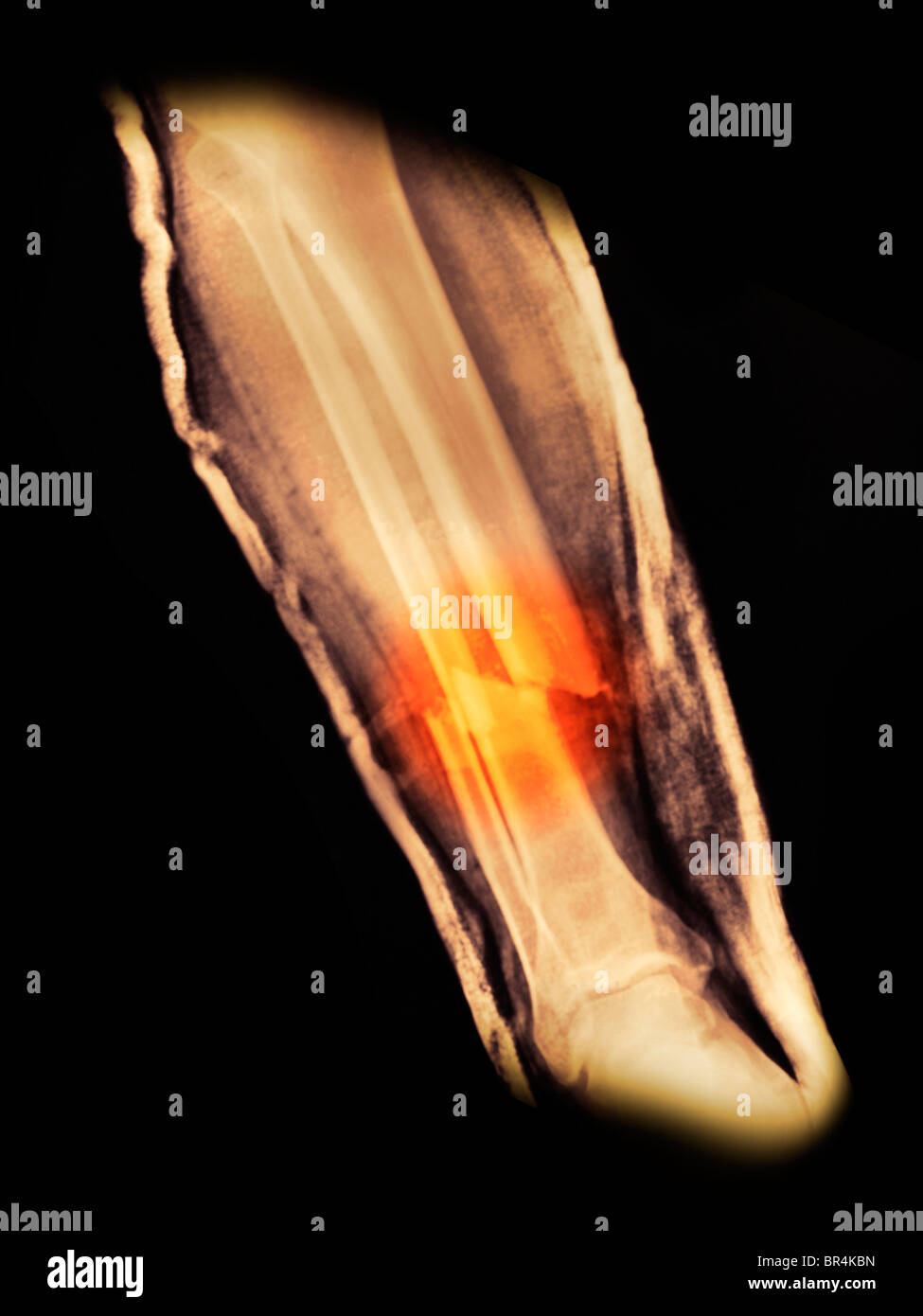 X-ray de la jambe d'un homme de 37 ans qui lui a fracturé le tibia et le péroné dans un accident de moto Banque D'Images