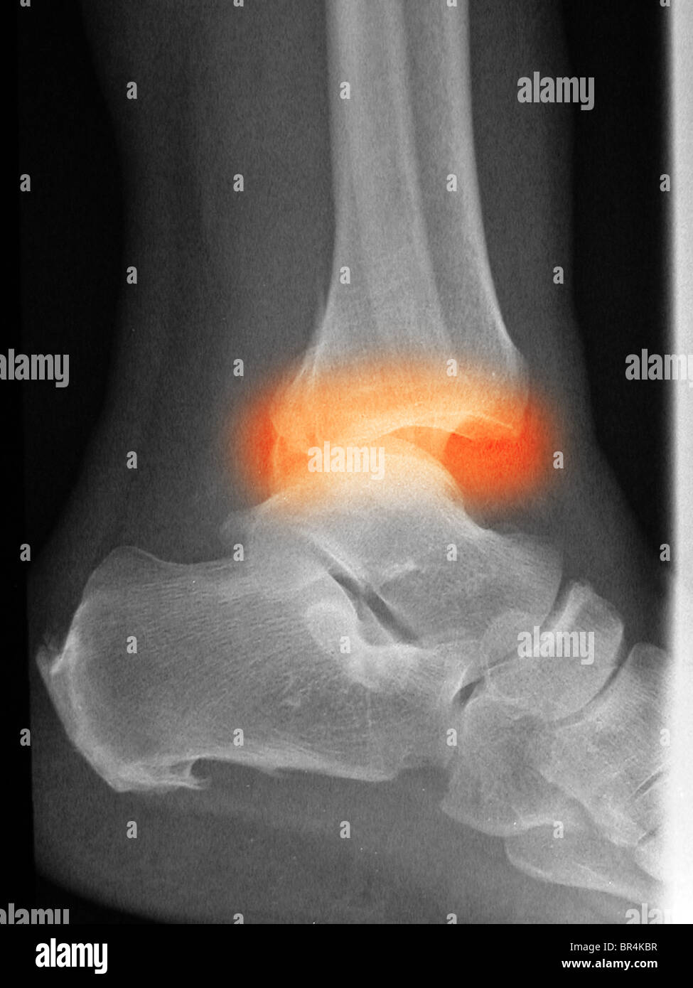 X-ray montrant une fracture et luxation de la cheville dans un vieil homme de 66 ans Banque D'Images