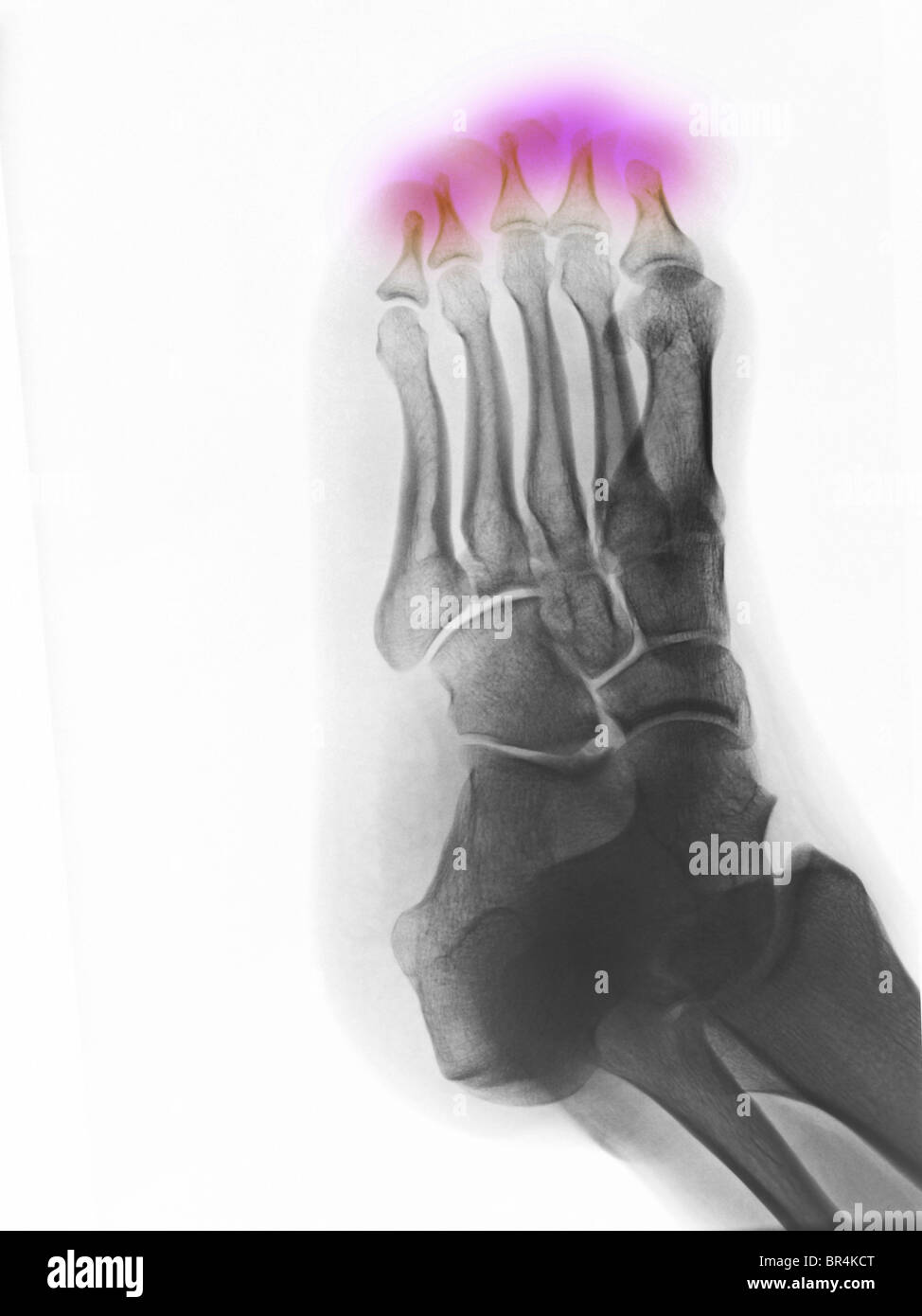 Pied x-ray of a 25 year old man montrant l'extrémité distale l'absence congénitale d'os dans les orteils Banque D'Images