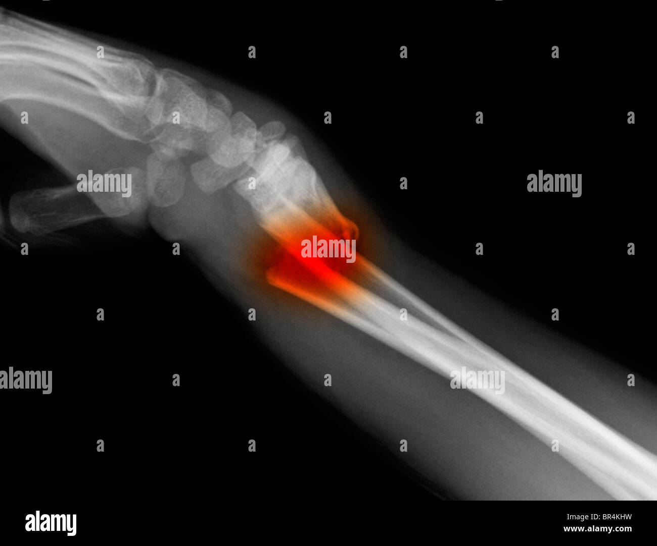 X-ray de l'avant-bras d'un garçon de 11 ans, montrant une fracture oblique de la partie distale du cubitus et radius Banque D'Images