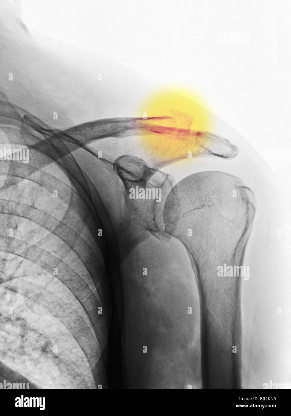 Radiographie d'une fracture de la clavicule dans un vieil homme de 72 ans Banque D'Images