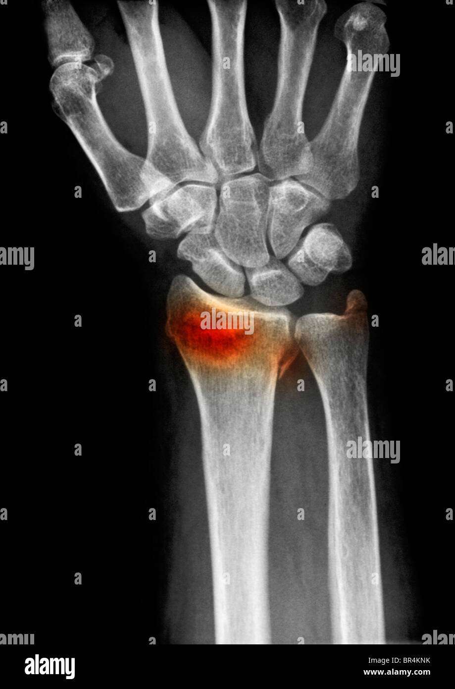 Poignet x-ray d'une femme de 63 ans qui est tombé et s'est fracturé la partie distale du radius et cubitus Banque D'Images