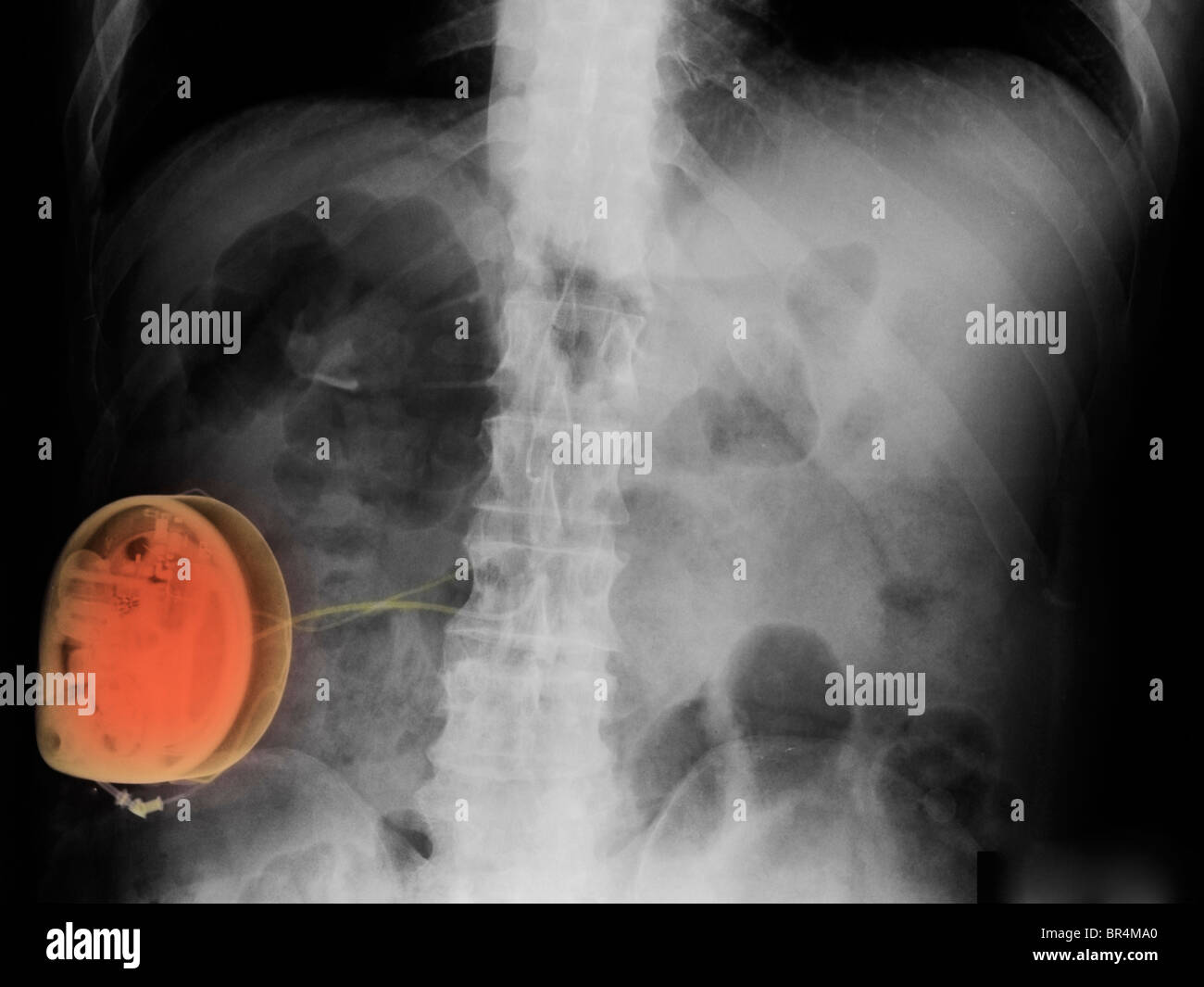 X-ray montrant un stimulateur de la moelle épinière employé pour traiter la douleur Banque D'Images