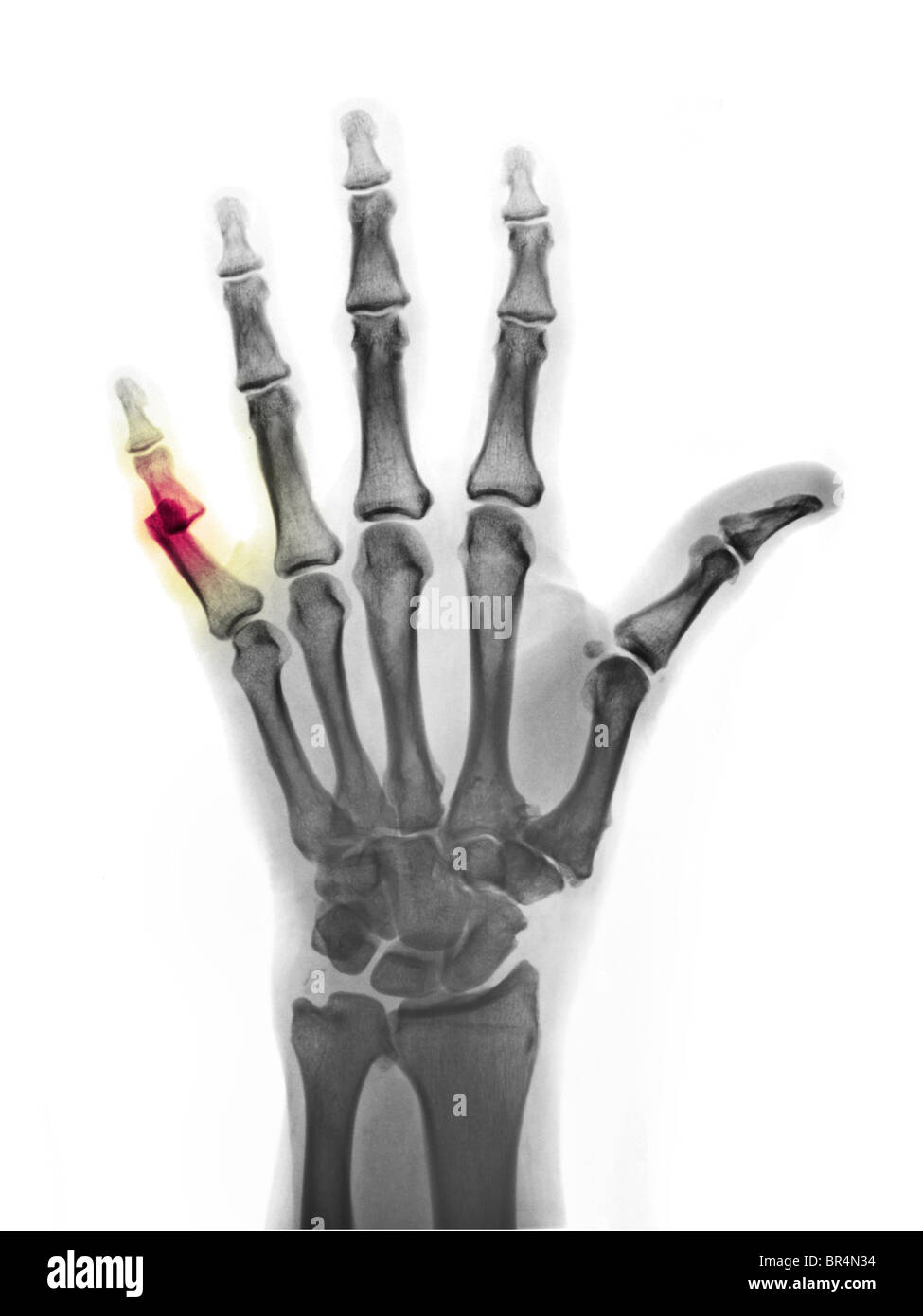 X-ray la main d'un homme de 60 ans qui ont disloqué son 5ème doigt à l'articulation interphalangienne proximale. Banque D'Images