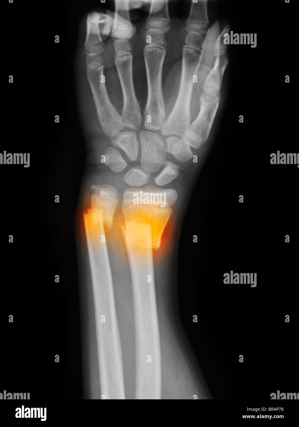 Fracture du cubitus et du radius distal avec déplacement Banque D'Images