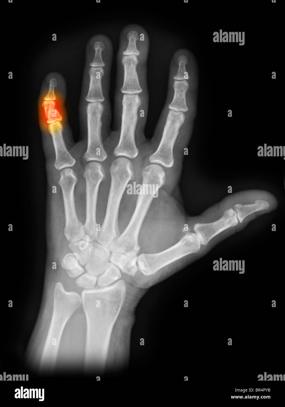 X-ray colorisée de la main montrant une fracture du 5ème doigt Banque D'Images