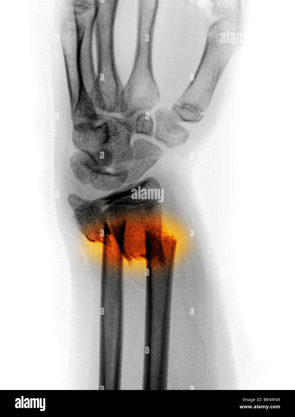 Radius et cubitus déplacées fracture de l'avant-bras d'une jeune fille de 12 ans Banque D'Images