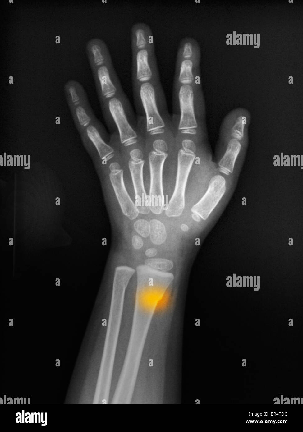 X-ray de l'avant-bras d'une fillette de 3 ans montrant une boucle, greenstick, fracture de l'extrémité distale du radius et du cubitus Banque D'Images