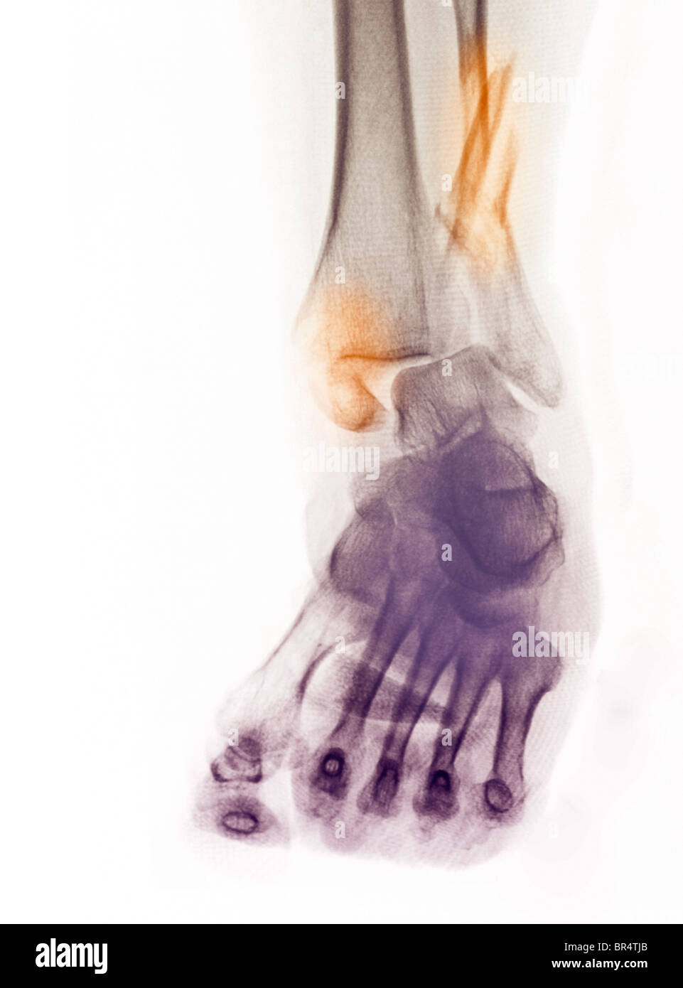 X-ray montrant une fracture et luxation de la cheville dans un homme âgé de 64 ans. Banque D'Images